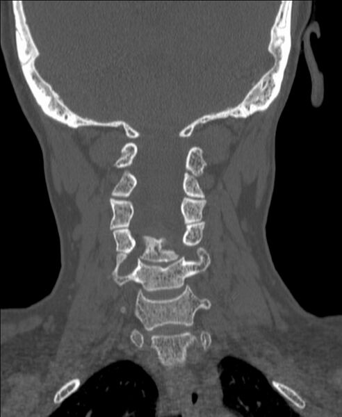 File:Atlanto-occipital assimilation with basilar invagination (Radiopaedia 70122-80188 Coronal bone window 127).jpg