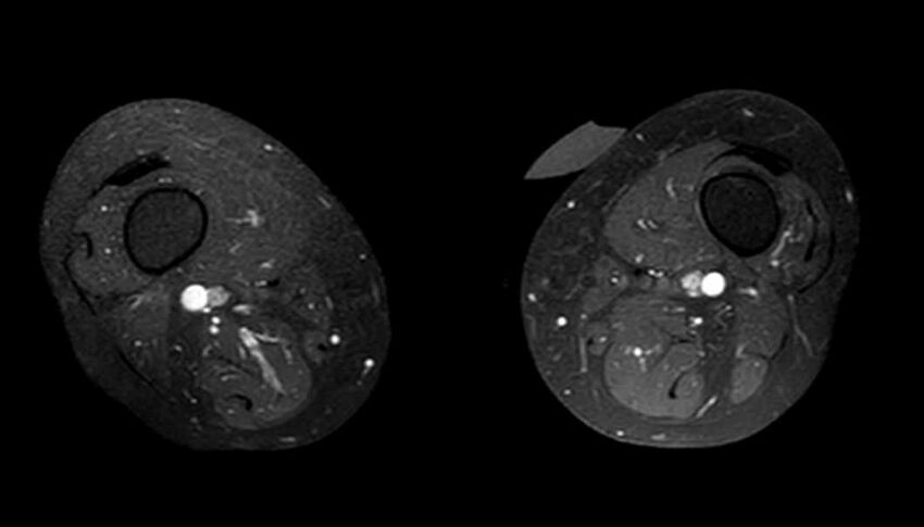 Atypical lipomatous tumor - thigh (Radiopaedia 68975-78734 Axial T1 C+ fat sat 27).jpg