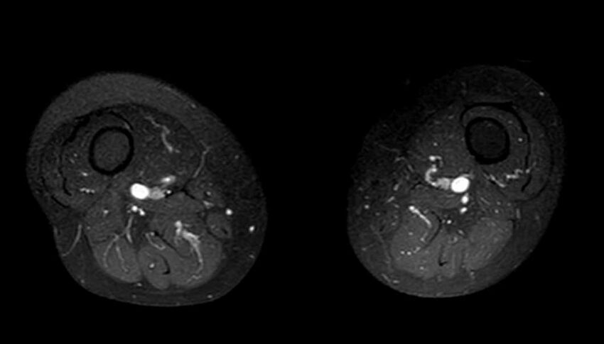 Atypical lipomatous tumor - thigh (Radiopaedia 68975-78734 Axial T1 C+ fat sat 35).jpg
