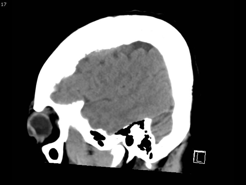 File:Atypical meningioma - intraosseous (Radiopaedia 64915-73867 C 15).jpg