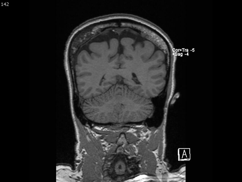 Atypical meningioma - intraosseous (Radiopaedia 64915-74572 Coronal T1 142).jpg