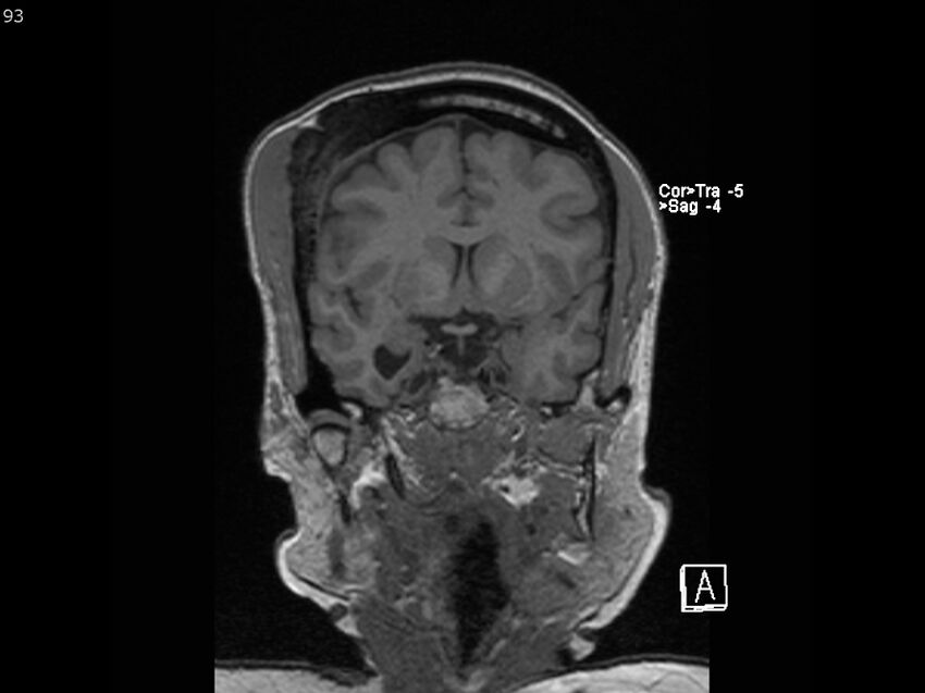 Atypical meningioma - intraosseous (Radiopaedia 64915-74572 Coronal T1 93).jpg