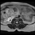 Atypical retroperitoneal lymphocoeles with large leiomyoma of uterus (Radiopaedia 32084-33027 Axial T2 2).jpg
