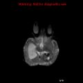 Atypical teratoid rhabdoid tumor (Radiopaedia 10712-11183 Axial DWI 10).jpg