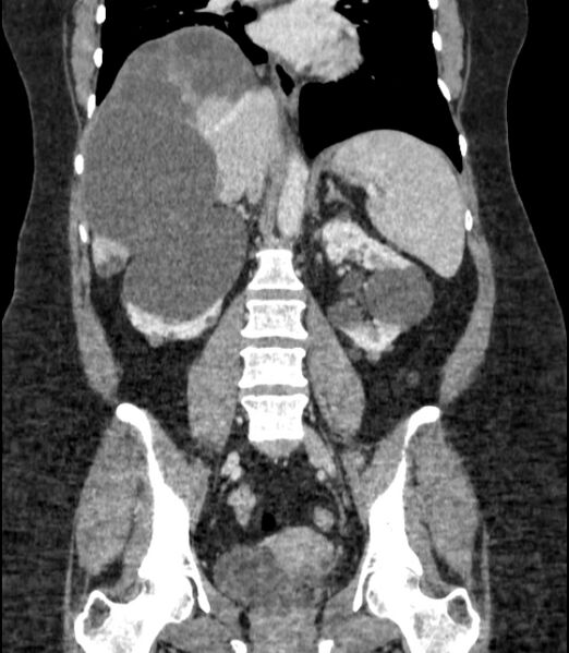 File:Autosomal dominant polycystic kidney disease (Radiopaedia 57124-64017 B 47).jpg