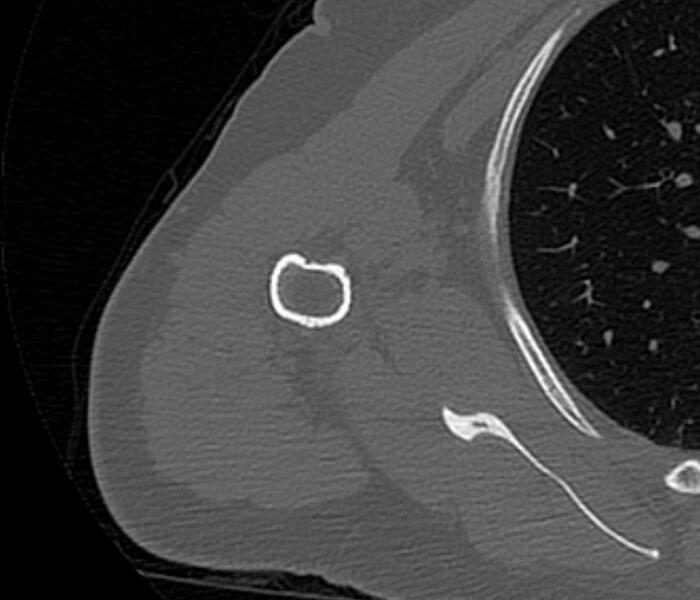 File:Avulsion fracture - greater tuberosity of humerus (Radiopaedia 71216-81514 Axial bone window 63).jpg