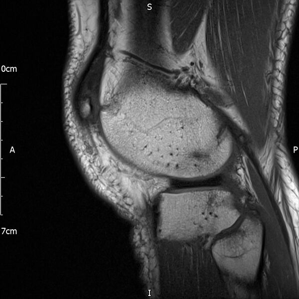 File:Avulsion fracture of the fibular head (Radiopaedia 74804-85808 D 27).jpg