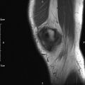 Avulsion fracture of the fibular head (Radiopaedia 74804-85808 D 5).jpg