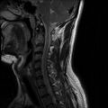 Axis fracture - MRI (Radiopaedia 71925-82375 Sagittal T2 6).jpg