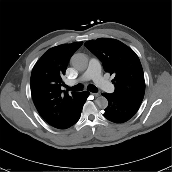 File:Azygos venous system anatomy (CT pulmonary angiography) (Radiopaedia 25928-26077 Axial C+ CTPA 35).jpg