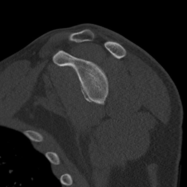 File:Bankart lesion (Radiopaedia 22771-22798 Sagittal bone window 30).jpg