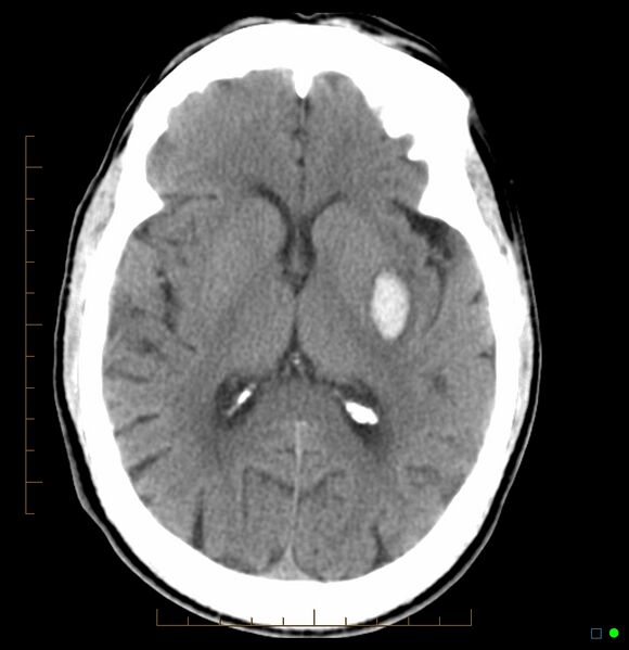 File:Basal ganglia hemorrhage (CT) (Radiopaedia 2672-6384 Axial non-contrast 1).jpg