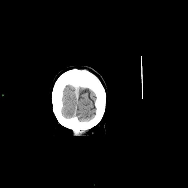 File:Basal ganglia hemorrhage (Radiopaedia 58348-65471 Coronal non-contrast 9).jpg