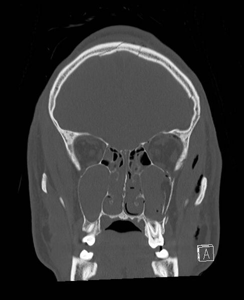 File:Base of skull fracture with bilateral Le Fort fractures (Radiopaedia 47094-51638 Coronal bone window 71).jpg
