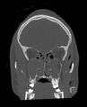 Base of skull fracture with bilateral Le Fort fractures (Radiopaedia 47094-51638 Coronal bone window 71).jpg