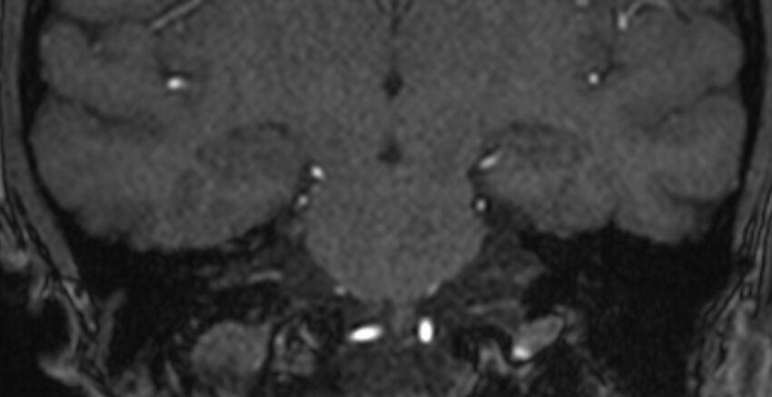 Basilar artery fenestration (Radiopaedia 74537-85455 Coronal MRA TOF 67).jpg