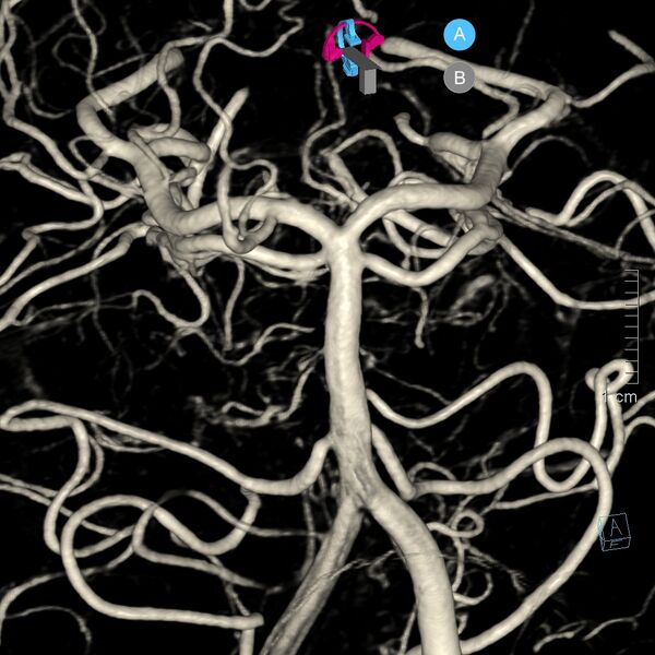 File:Basilar artery perforator aneurysm (Radiopaedia 82455-97734 3D view left VA 44).jpg