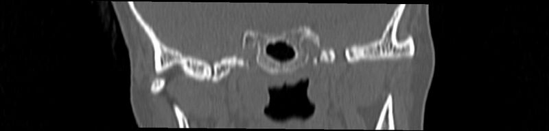 File:Basilar impression (Radiopaedia 52411-58522 Coronal bone window 48).jpg
