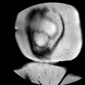 Benign seromucinous cystadenoma of the ovary (Radiopaedia 71065-81300 F 3).jpg