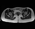 Bicornuate bicollis uterus (Radiopaedia 61626-69616 Axial T2 30).jpg