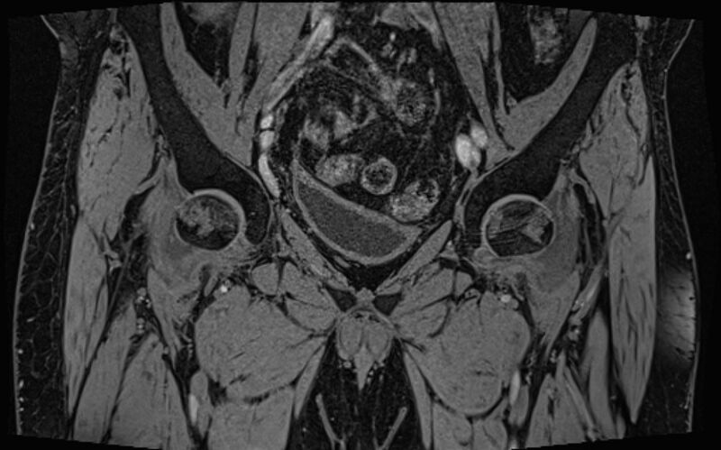 File:Bilateral avascular necrosis of femoral head (Radiopaedia 77116-89078 Coronal T2 we 64).jpg