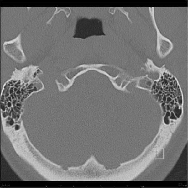 File:Bilateral cervical ribs (Radiopaedia 25868-26017 Axial bone window 1).jpg