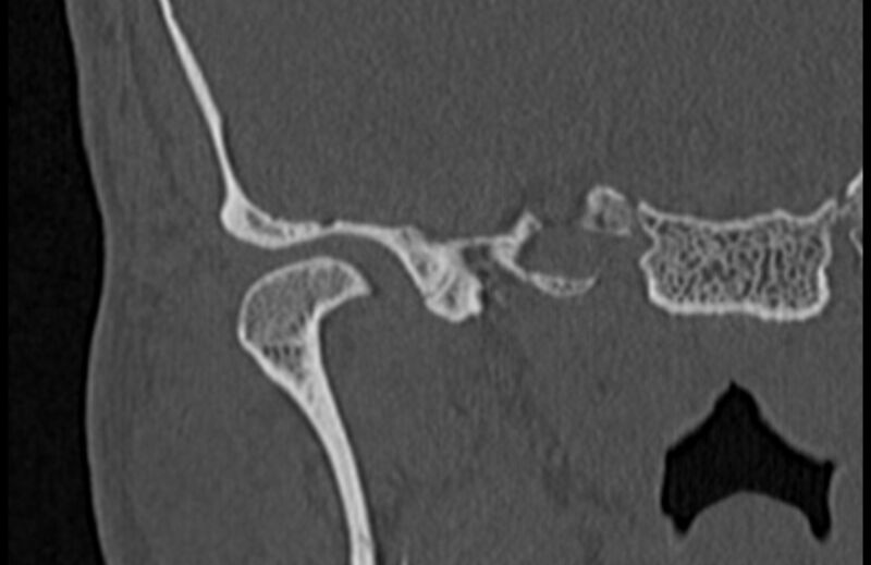 File:Bilateral cholesteatoma (Radiopaedia 54898-61172 Coronal bone window 3).jpg