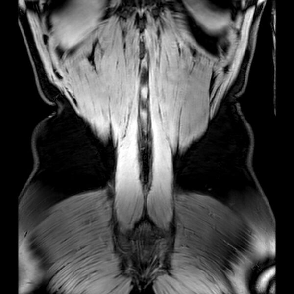 File:Bilateral conjoined nerve roots at different levels (Radiopaedia 73312-84063 Coronal WE 55).jpg