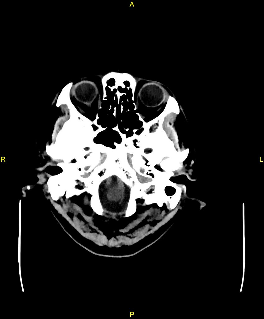 Bilateral isodense subdural hematomas (Radiopaedia 88621-105325 Axial non-contrast 11).jpg