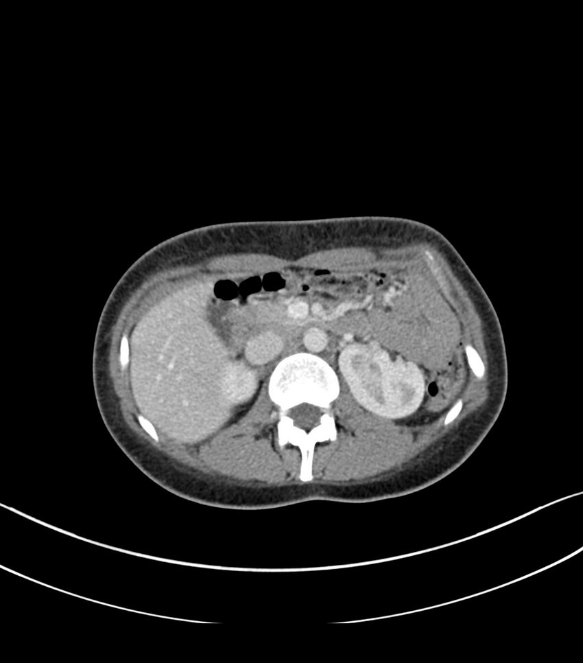 Bilateral kidney malrotation (Radiopaedia 72227-82749 A 16).jpg