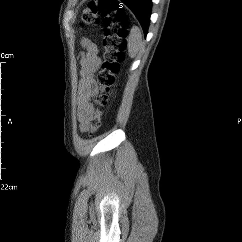 Bilateral medullary nephrocalcinosis with ureteric calculi (Radiopaedia 71269-81569 C 21).jpg