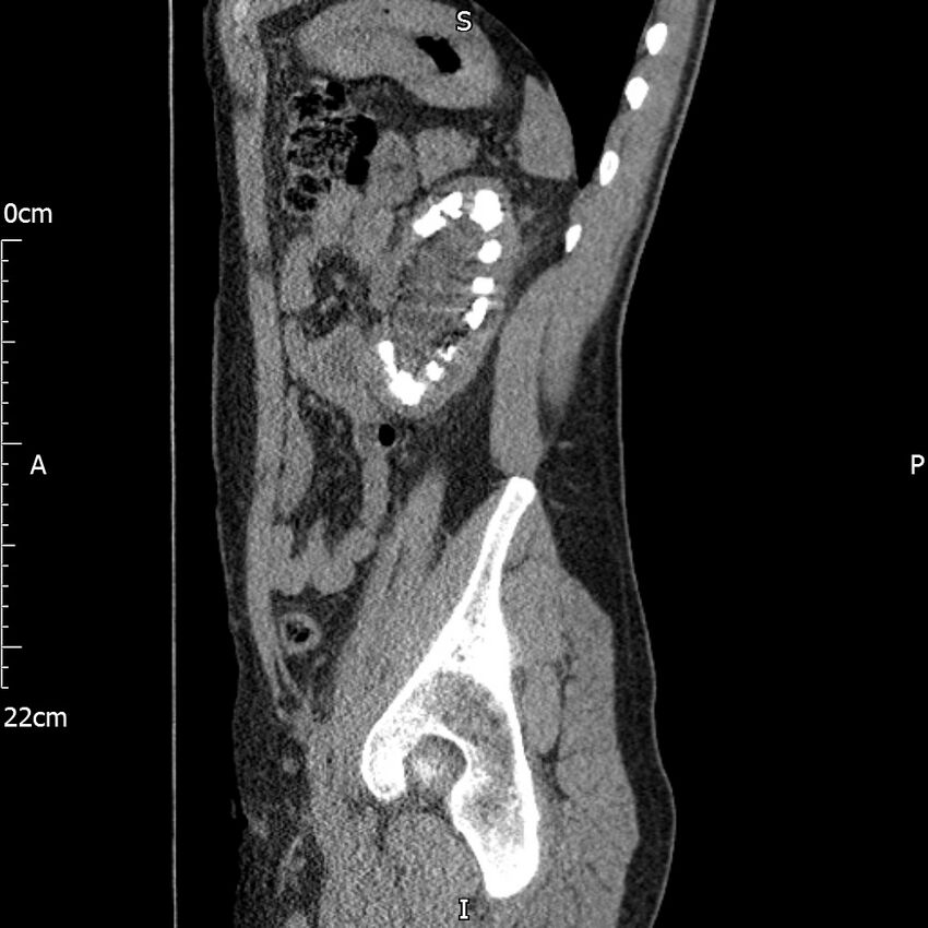 Bilateral medullary nephrocalcinosis with ureteric calculi (Radiopaedia 71269-81569 C 37).jpg