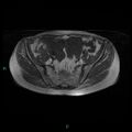 Bilateral ovarian fibroma (Radiopaedia 44568-48293 Axial T1 8).jpg