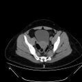 Bilateral ovarian mature cystic teratomas (Radiopaedia 79373-92457 Axial non-contrast 63).jpg
