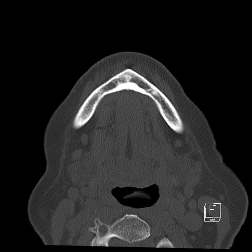 Bilateral palatine tonsilloliths on OPG and CT (Radiopaedia 75167-86247 Axial bone window 54).jpg
