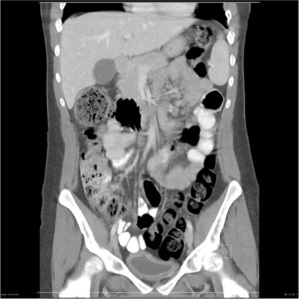 File:Bilateral ureteritis and cystitis (Radiopaedia 25340-25594 B 16).jpg