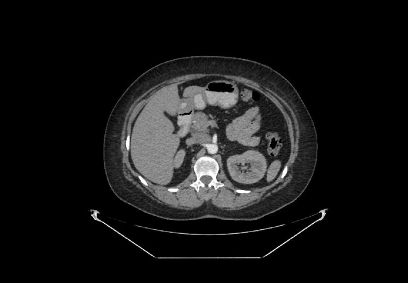 File:Bilateral urolithiasis with incidentally detected splenic artery aneurysm and left inferior vena cava (Radiopaedia 44467-48127 A 27).jpg