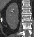 Bile leak from accessory duct(s) of Luschka post cholecystectomy (Radiopaedia 40736-43389 B 58).jpg