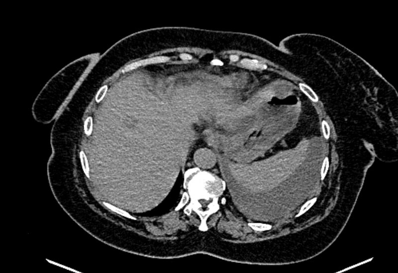 File:Biliary pancreatitis (Radiopaedia 72289-82823 Axial non-contrast 53).jpg