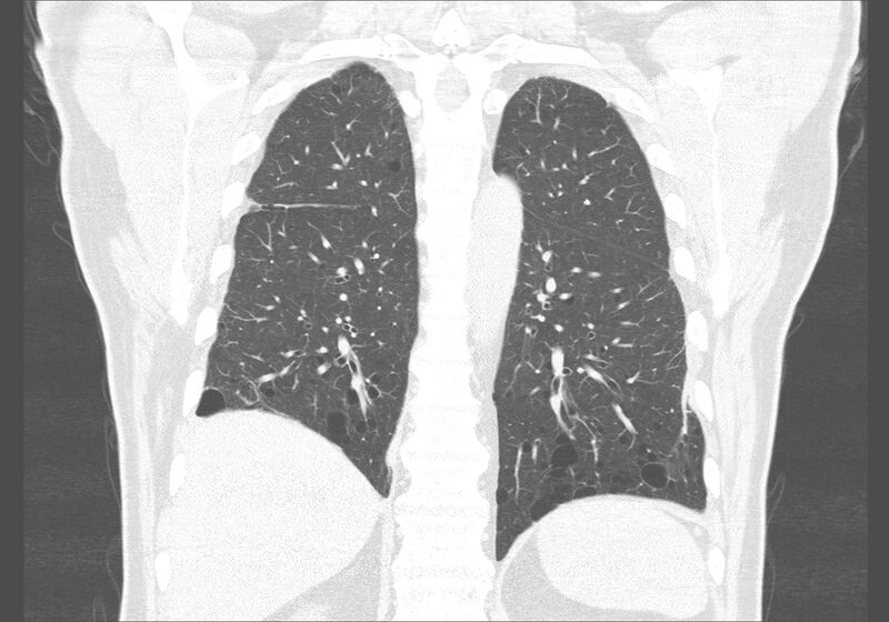 File:Birt-Hogg-Dubé syndrome (Radiopaedia 52578-58491 Coronal lung window 45).jpg