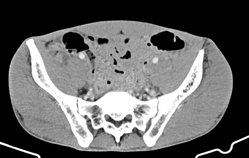 File:Blunt injury to the small bowel (Radiopaedia 74953-85987 A 150).jpg