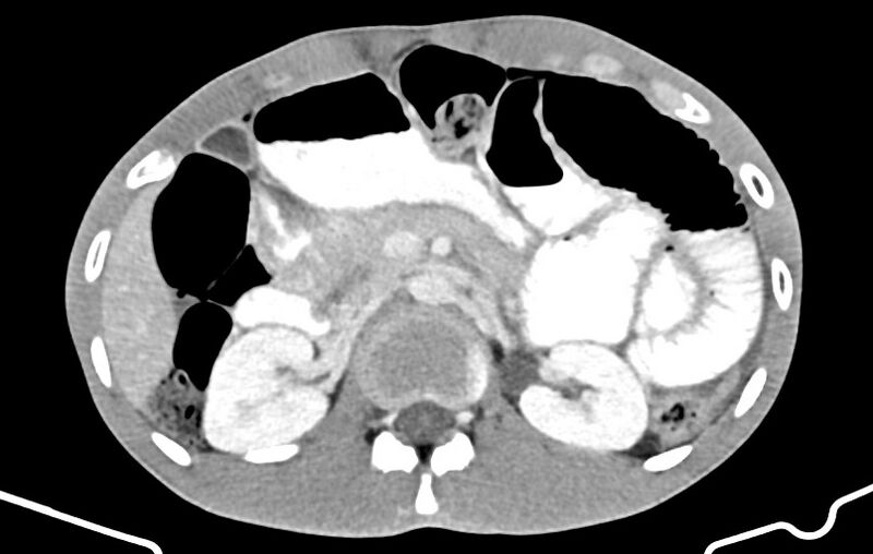 File:Blunt injury to the small bowel (Radiopaedia 74953-85987 A 54).jpg