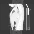 Bochdalek diaphragmatic hernia (Radiopaedia 38866-41059 Coronal lung window 21).jpg