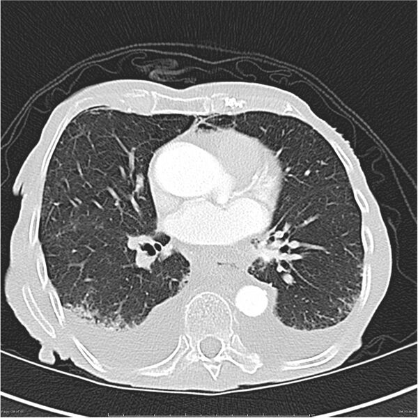File:Boerhaave syndrome (Radiopaedia 26240-26362 Axial lung window 28).jpg