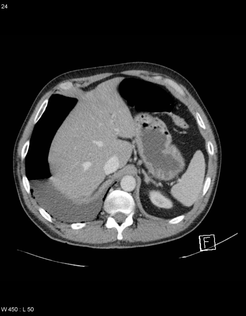 Boerhaave syndrome with tension pneumothorax (Radiopaedia 56794-63603 A 12).jpg