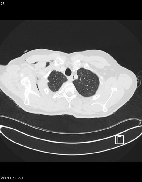 File:Boerhaave syndrome with tension pneumothorax (Radiopaedia 56794-63605 Axial lung window 12).jpg
