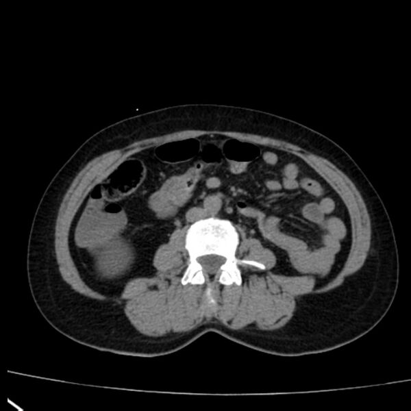 File:Bosniak renal cyst - type I (Radiopaedia 27479-27675 Axial non-contrast 51).jpg