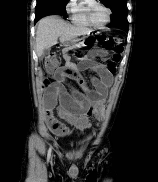 File:Bowel obstruction from colon carcinoma (Radiopaedia 22995-23028 C 19).jpg