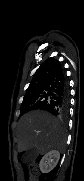 File:Brachiocephalic trunk pseudoaneurysm (Radiopaedia 70978-81191 C 22).jpg