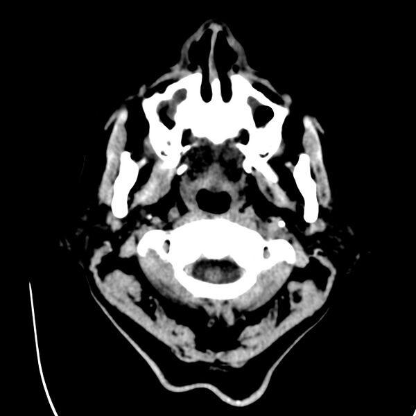 File:Brain Pantopaque remnants (Radiopaedia 78403-91048 Axial non-contrast 6).jpg
